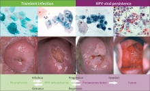 防預子宮頸癌的HPV治療性疫苗研究