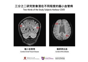 腦小血管病是中風及認知障礙症的主要成因，目前可透過影像檢查發現病變。