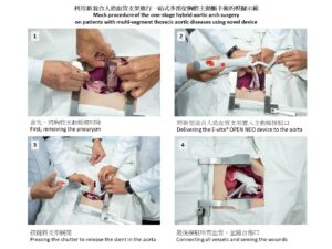 Mock procedure of the one-stage hybrid aortic arch surgery on patients with multi-segment thoracic aortic diseases using novel device.