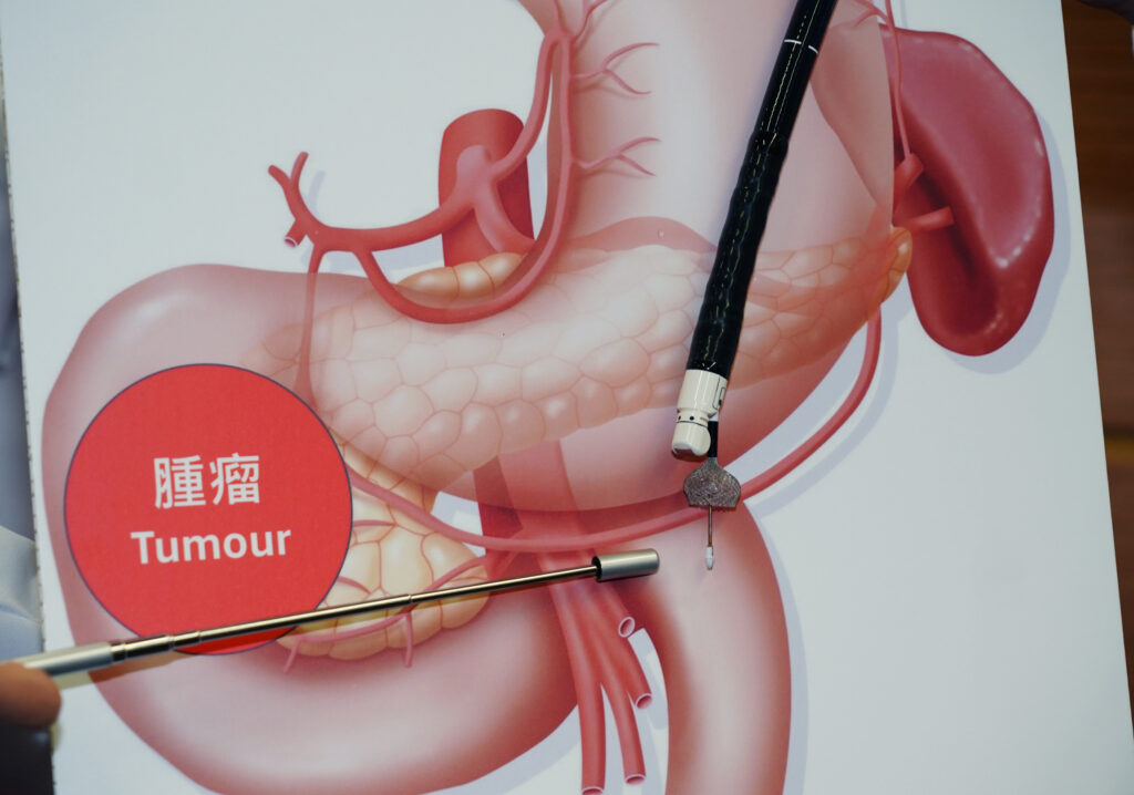 CU Medicine was the first to introduce EUS-GE, a close-to-non-invasive endoscopic procedure that creates a connection between the stomach and small intestine as a bypass, to treat GOO patients in Hong Kong.