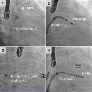 The diagrams show the procedures of a combined transcatheter mitral and tricuspid TEER. <br />
Pic 1: The tricuspid steerable guide catheter (SGC) is inserted into the left atrium (LA) to deliver a device to repair the prolapse or flail gaps in the mitral valve.<br />
Pic 2: Mitral TEER is completed through the tricuspid catheter. <br />
Pic 3: After completion of mitral TEER, the tricuspid SGC is pulled back to right atrium (RA). <br />
Pic 4: Tricuspid TEER is performed.