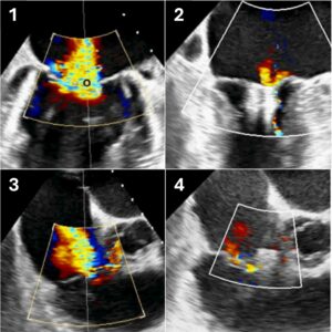 The diagrams show the before and after effect of combined TEER. The mitral regurgitation reduced from severe (Pic 1) to mild (Pic 2). And the tricuspid regurgitation also reduced from severe (Pic 3) to mild (Pic 4).