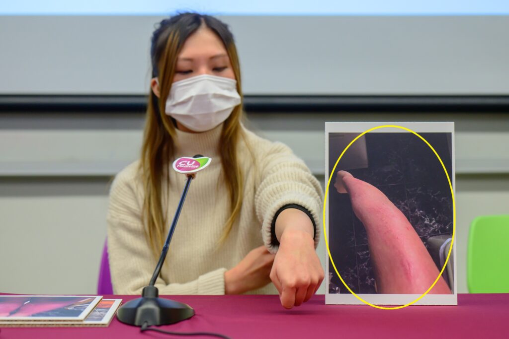 Eczema severity can be evaluated through redness, thickness, degree of dryness, wound and pus. The eczema condition of Venus’ forearm was rated 10 (very severe) in her worst time (shown in the picture circled in yellow) and has improved to 2 with only slightly red and dry skin.