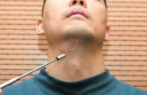 A stimulation cuff is implanted at the nerve branches underneath the tongue. Electric stimulation helps unhinder protrusion of a stiffened tongue during sleep. The scar is around 5cm long which will become obscure one year after surgery.