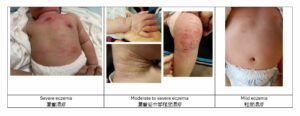 Photos showing different severity of eczema.